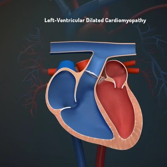 Cross-section illustration of left ventricular dilated cardiomyopathy